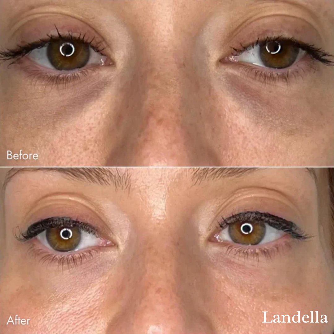 🔥Hot Sale 49% OFF💥Landella MicroGlow Patches