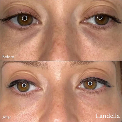 🔥Hot Sale 49% OFF💥Landella MicroGlow Patches